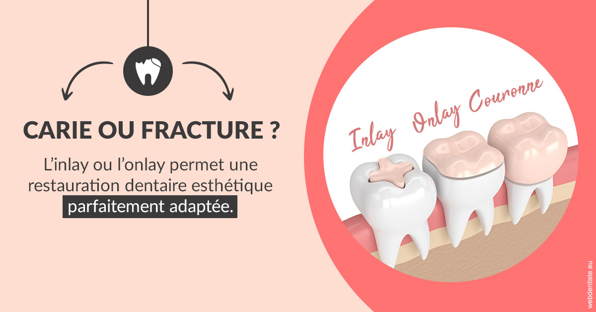 https://dr-devoldere-gauthier.chirurgiens-dentistes.fr/T2 2023 - Carie ou fracture 2