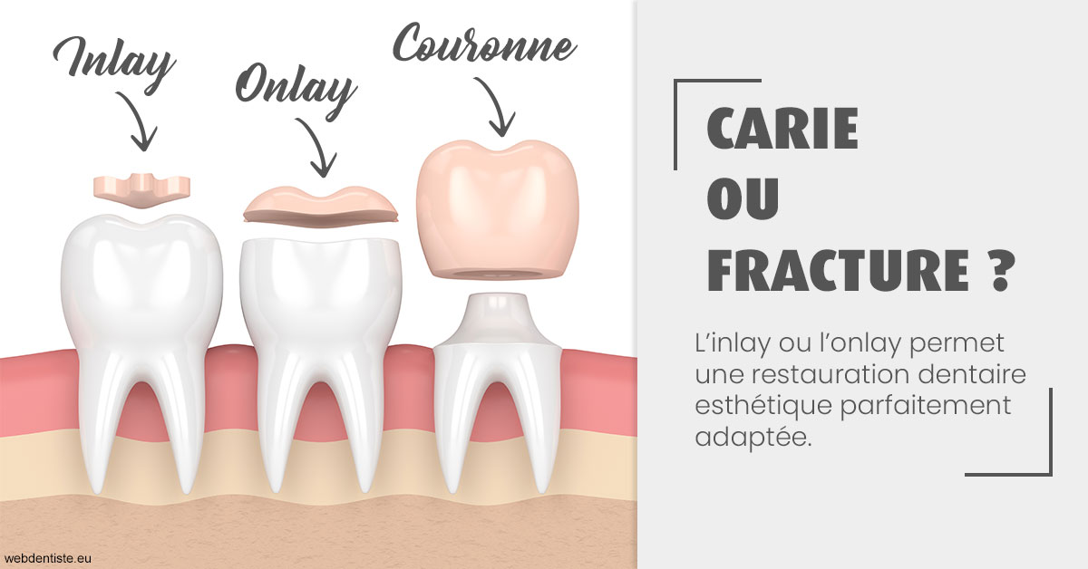 https://dr-devoldere-gauthier.chirurgiens-dentistes.fr/T2 2023 - Carie ou fracture 1
