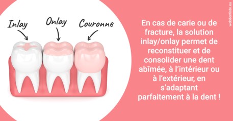 https://dr-devoldere-gauthier.chirurgiens-dentistes.fr/L'INLAY ou l'ONLAY 2