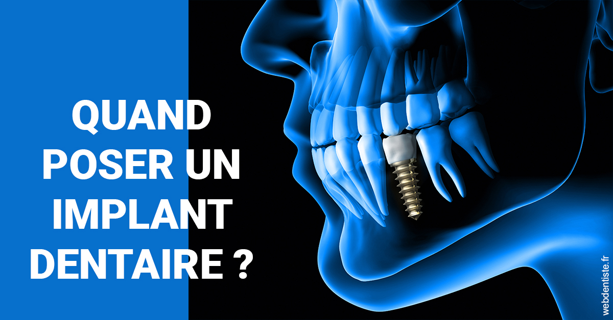 https://dr-devoldere-gauthier.chirurgiens-dentistes.fr/Les implants 1
