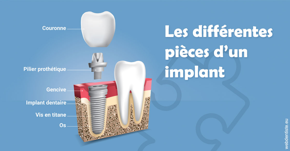 https://dr-devoldere-gauthier.chirurgiens-dentistes.fr/Les différentes pièces d’un implant 1
